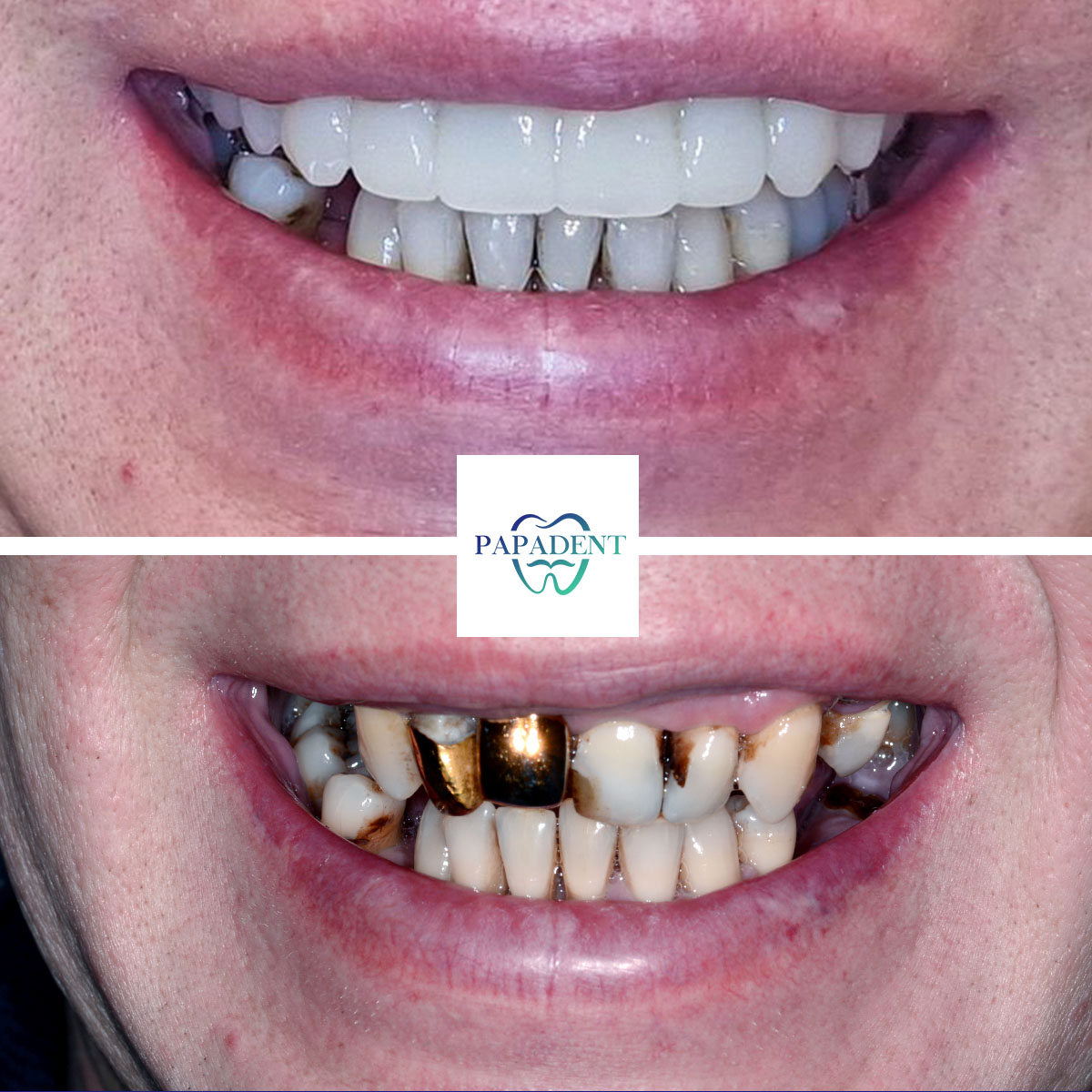 Igor - Alle Zähne auf vier Implantaten - Vorher und nachher 2