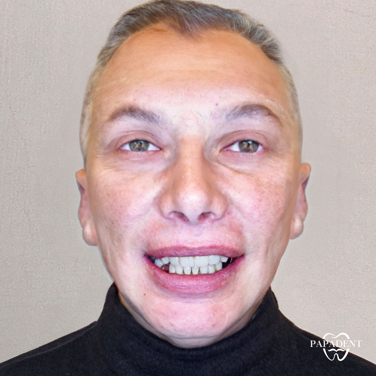 Igor - Alle Zähne auf vier Implantaten